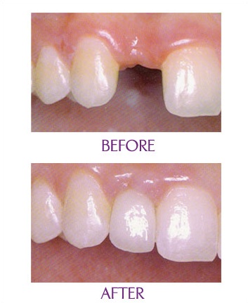 Invisible Braces: Invisalign® in Carmichael, CA - Marconi Dental Group